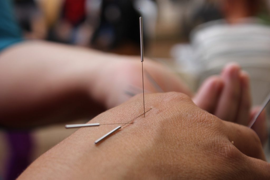 acupuncture on hand